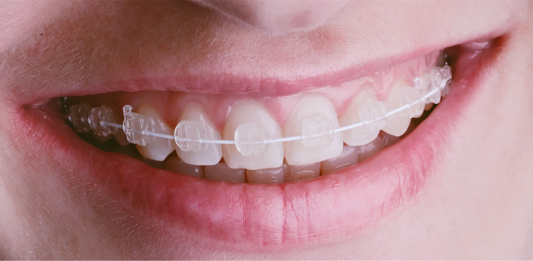 大人の矯正歯科治療について
