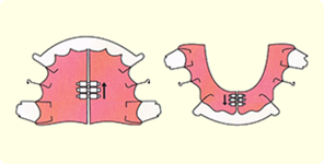 平行タイプ